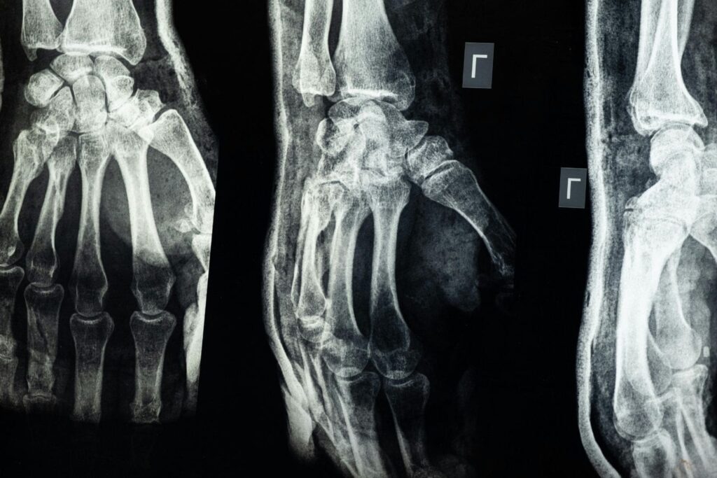 A medical X-ray film showing three different views of a human left hand and wrist against a black background. The bones of the fingers (phalanges), hand (metacarpals), and wrist (carpals) are clearly visible in white and gray. Two of the views have a capital "L" marker, indicating the left side.